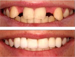 Read more about the article Six Signs That You Might Need Dentures