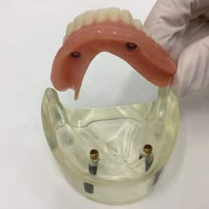 Read more about the article Implant Retained Dentures: Stability and Affordability