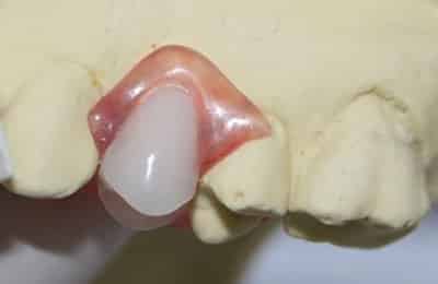 Chrome false teeth