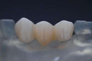 Read more about the article 5 Tips to Eat And Deal With Partial Dentures