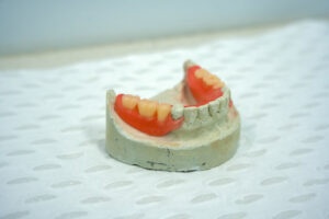 Read more about the article Partial dentures for back teeth