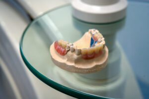 Back teeth Partial dentures and tooth replacement by advance oral dentures