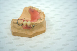 Read more about the article Partials for back teeth: A simple way to bring back your smile